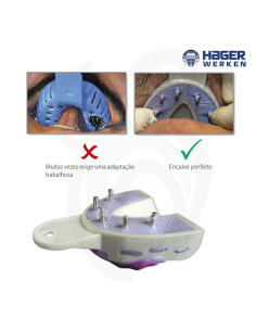 Miratray Implant 2